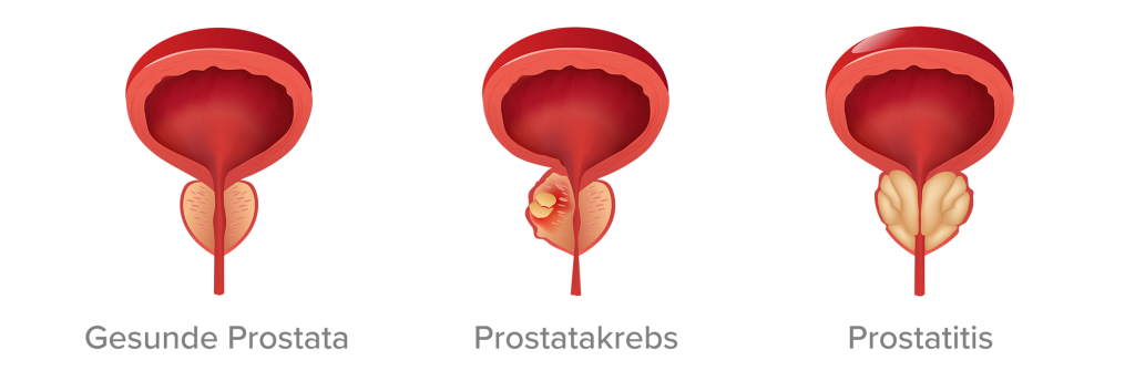 Abbildung einer gesunden Prostata, Prostatakrebs und Prostatitis