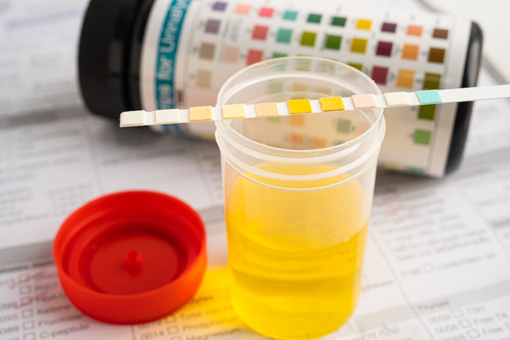 Urinbecher mit Teststreifen